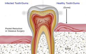 Osseous 3 300x188 - Gum Disease Surgical Procedures