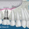Sinus Lift 3-Implant