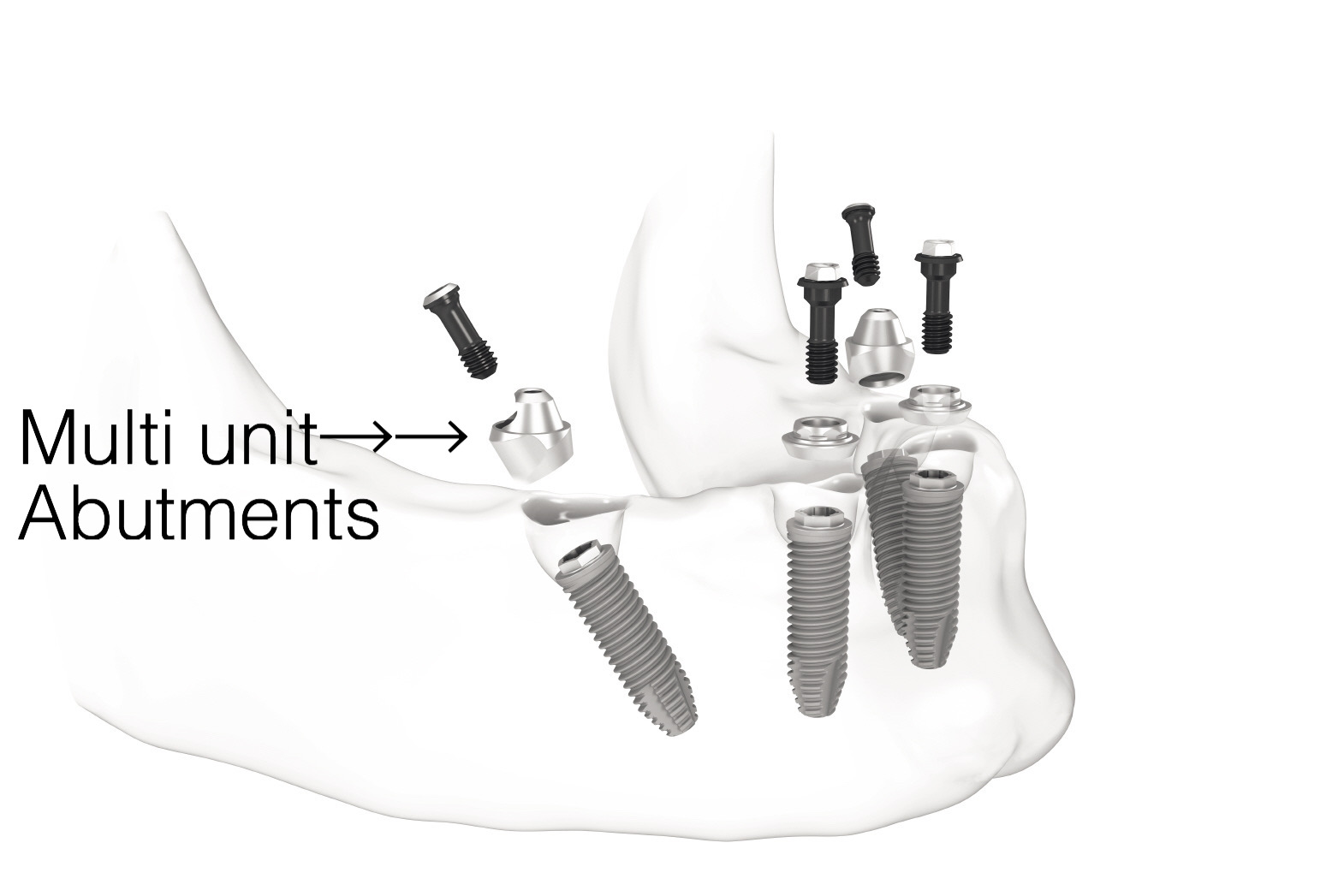 multi unit - Fixed Dentures-All on 4
