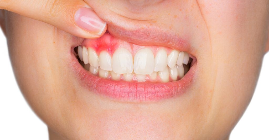 periodontal disease 1024x536 - Periodontal Maintenance