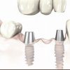 Untitled-2 Dental Implants Richboro