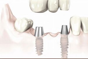 Untitled 2 7 300x200 - Multiple Dental Implants