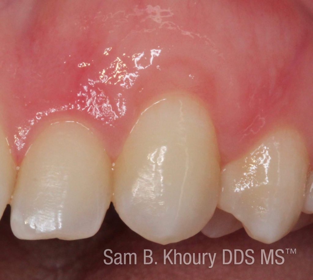 Gum Recession 1 after 1024x916 - Gum Grafts-Before and After