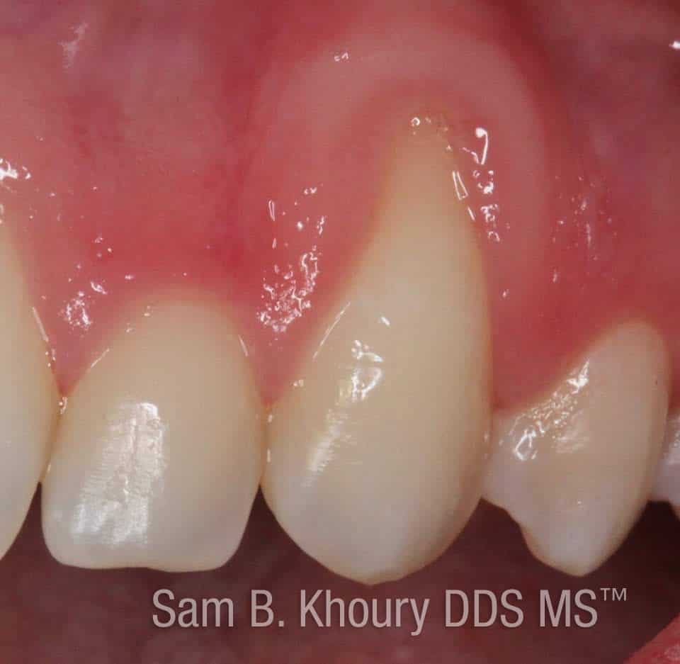 Gum Recession 1 before 1 - Gum Grafts-Before and After