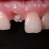 Yardley Dental Implants