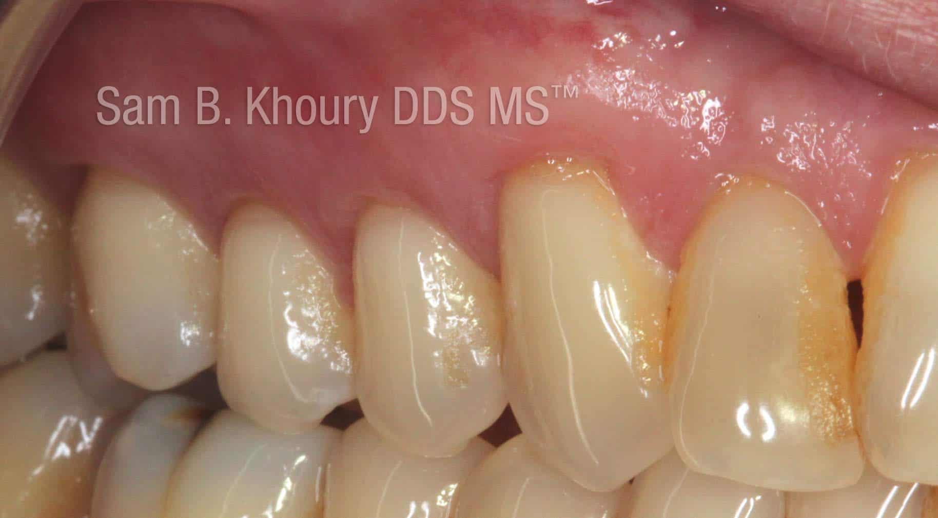 Gum Grafts Before and After Dr. Sam Khoury