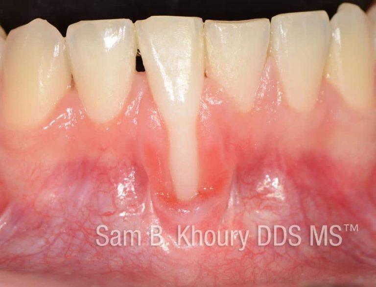 Gum Grafts Before and After Dr. Sam Khoury
