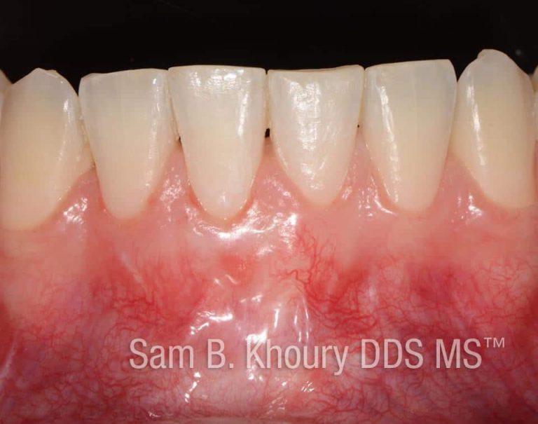 Gum Grafts Before and After Dr. Sam Khoury