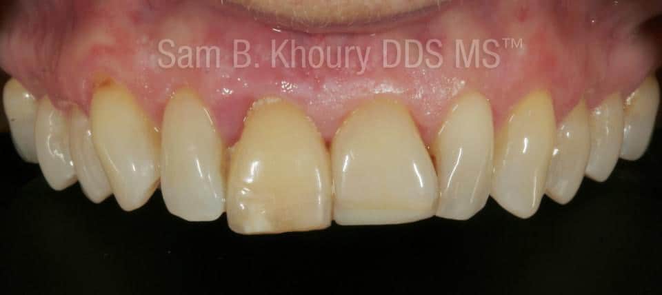 IMG 9746 - Dental Implants-Before and After