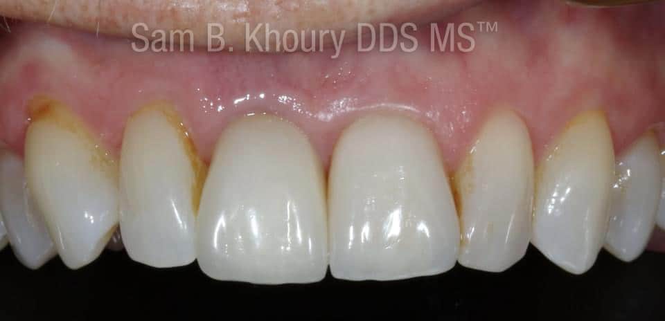 IMG 9757 - Dental Implants-Before and After