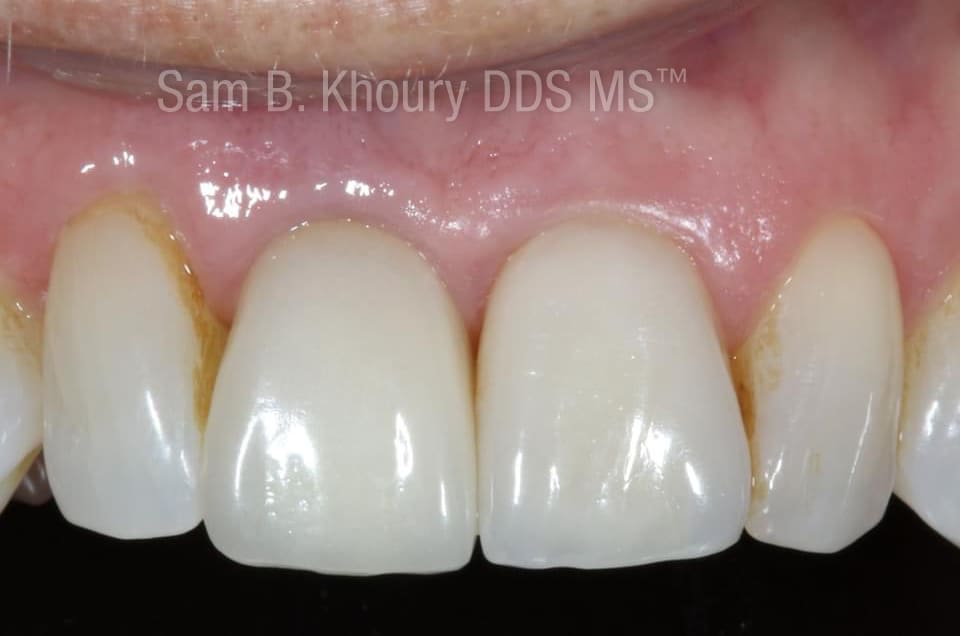 IMG 9758 - Dental Implants-Before and After