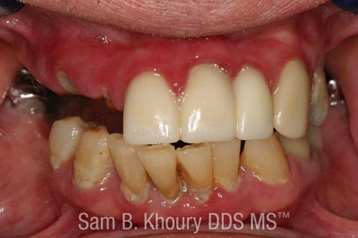IMG 9422 - Full Mouth Dental Implants