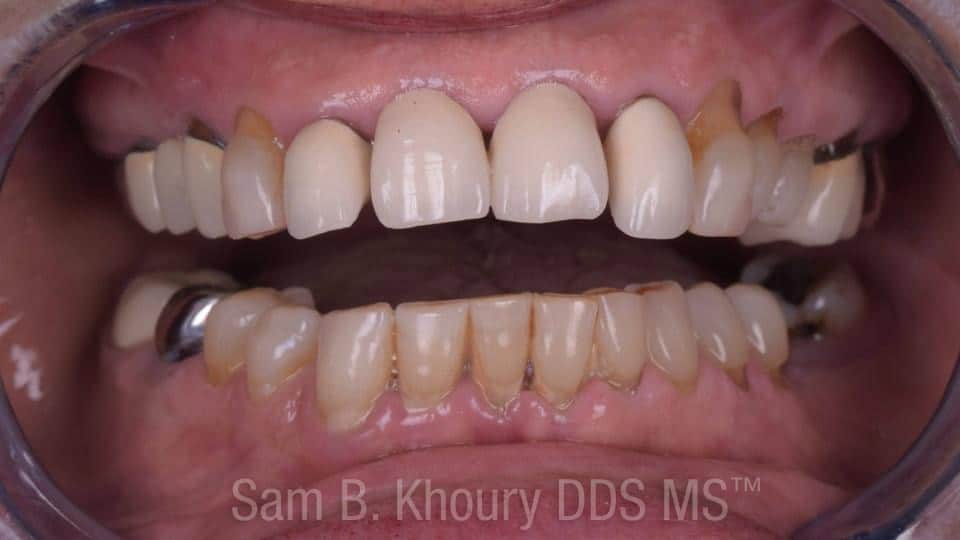 IMG 0316 - Full Mouth Dental Implants