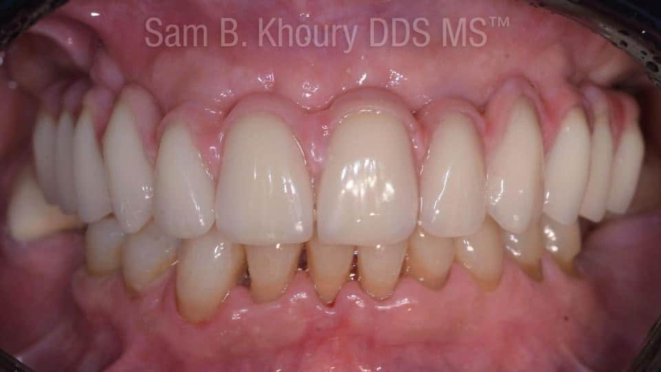 IMG 0317 - Full Mouth Dental Implants