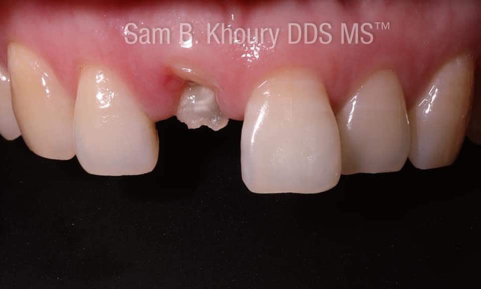 IMG 3051 - Dental Implants-Before and After