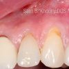 Gum Grafts-Before and After Gum Grafts-Before and After