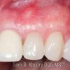 Gum Grafts-Before and After Gum Grafts-Before and After