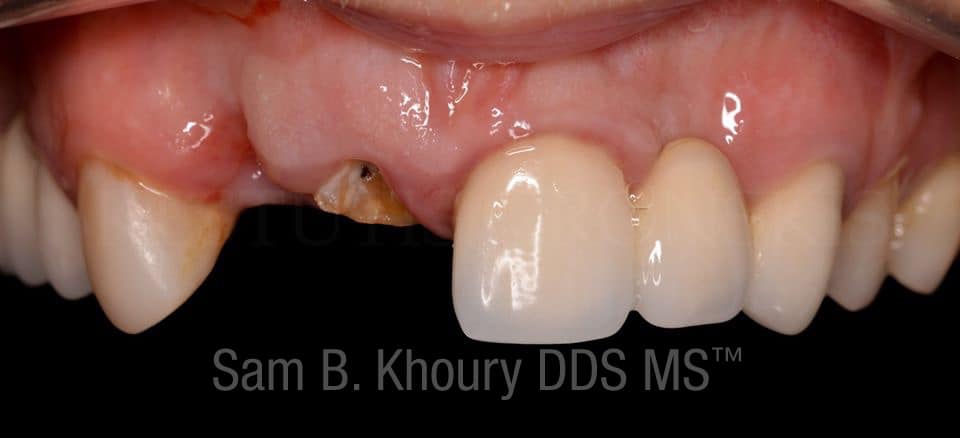 IMG 4015 - Dental Implants-Before and After