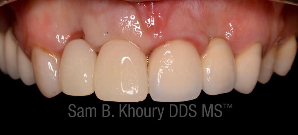 IMG 4019 1 - Dental Implants-Before and After