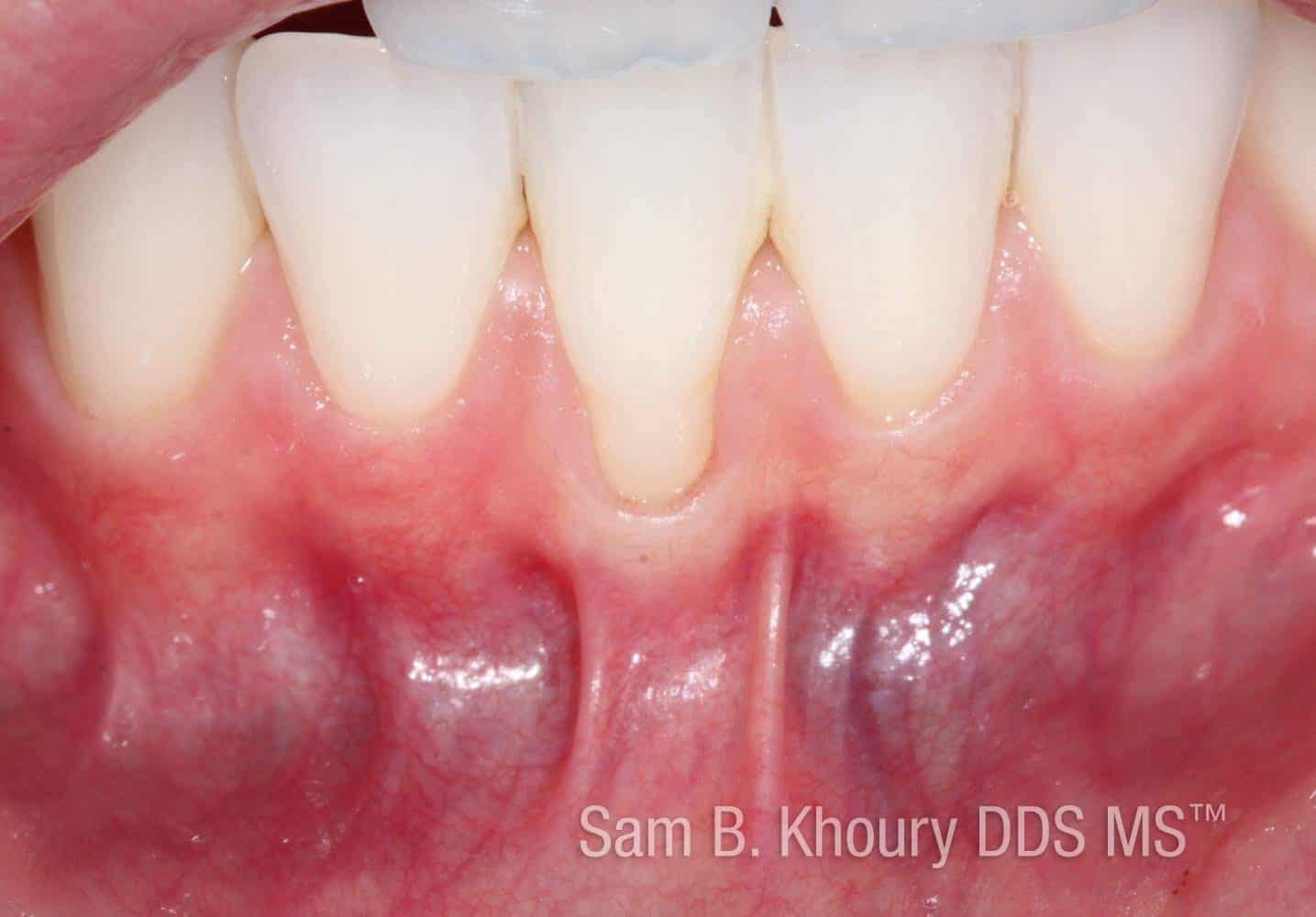 Gum Grafts Before and After Dr. Sam Khoury