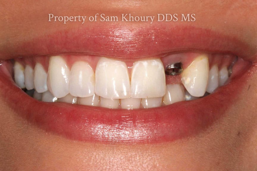 1 single implant tooth missing - Dental Implant Basics