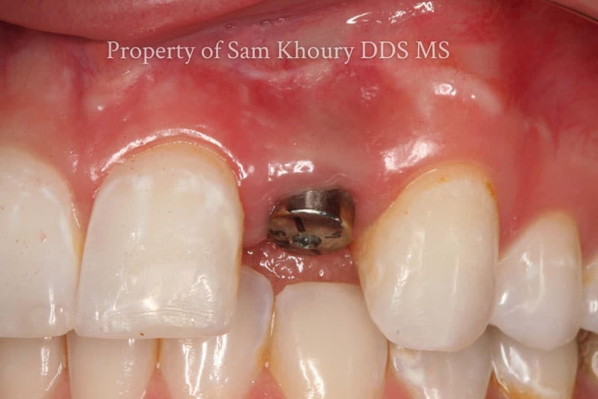 2 single implant dental implant placed - Dental Implant Basics