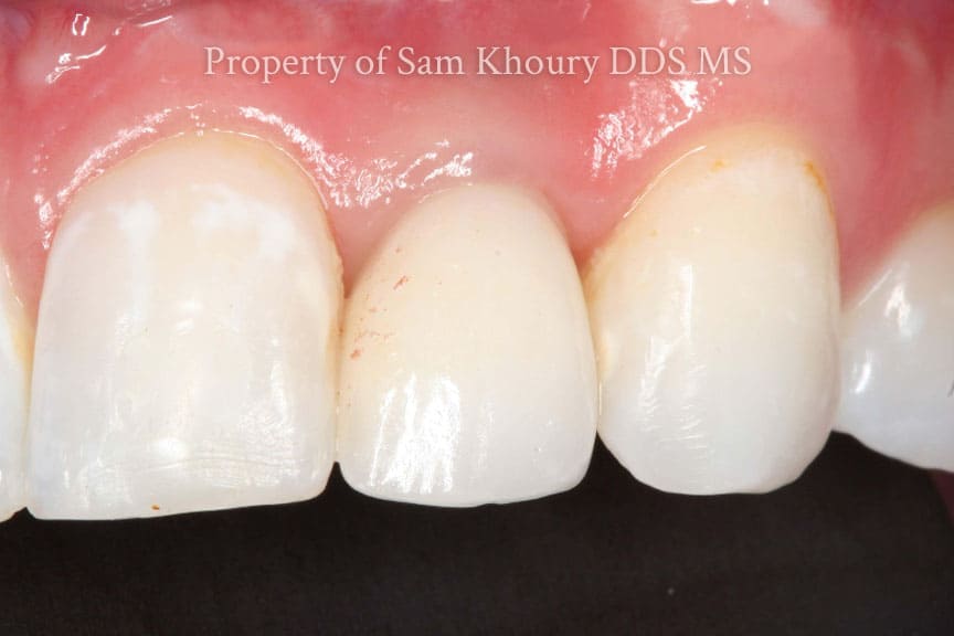 4 single implant final implant crown - Dental Implant Basics