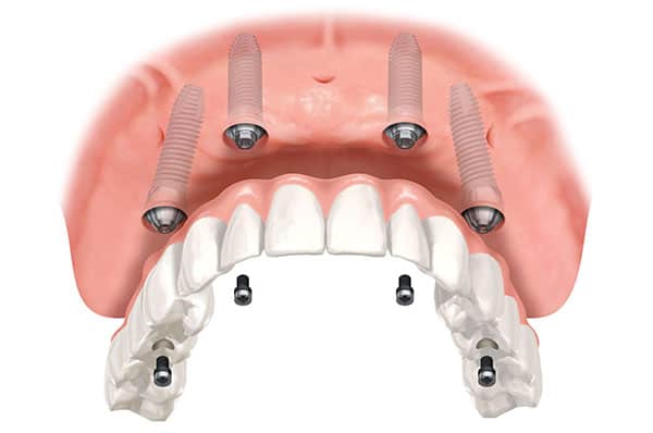 All on Four Illustration 2 - Fixed Dentures-All on 4