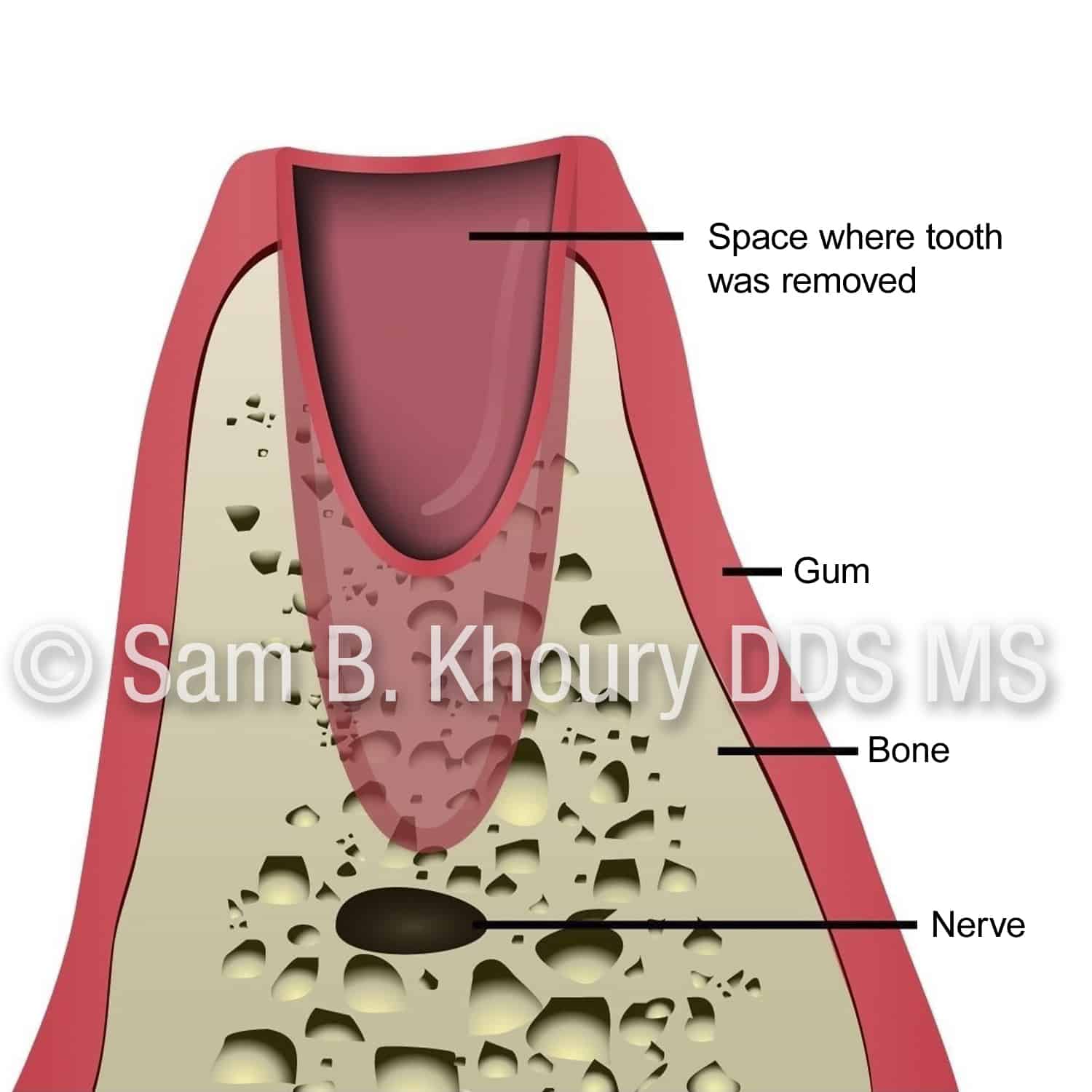 Before Dental chart - Immediate Dental Implants