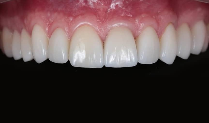 Dental Implants after - Immediate Dental Implants