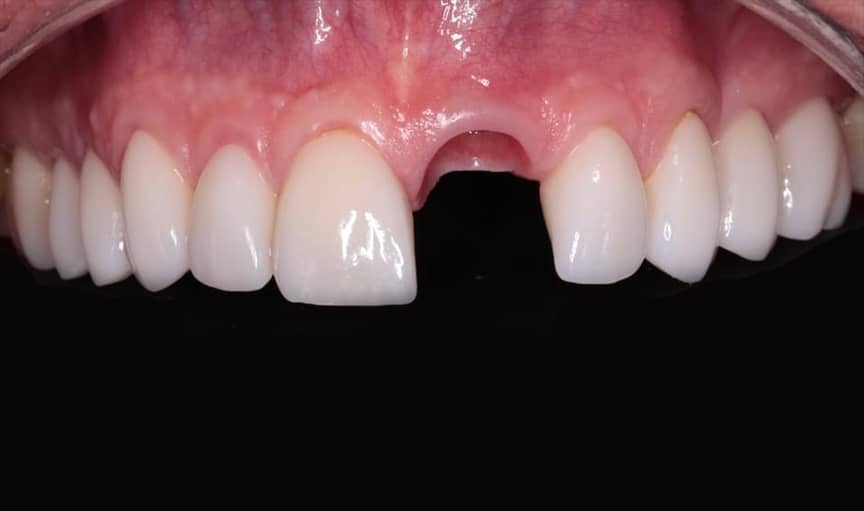 Dental Implants before - Immediate Dental Implants