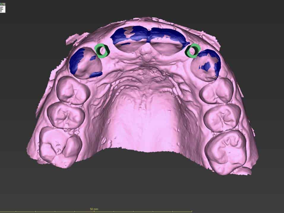Guided Dental Implant