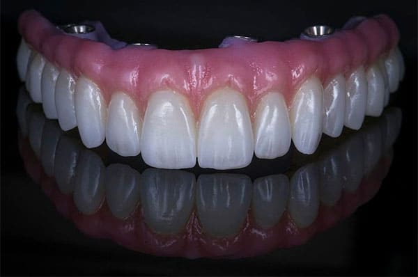 all on 4 Porcelian 1 - Fixed Dentures-All on 4