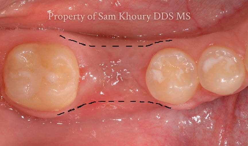 dental left graft after - Jaw Augmentation & Expansion