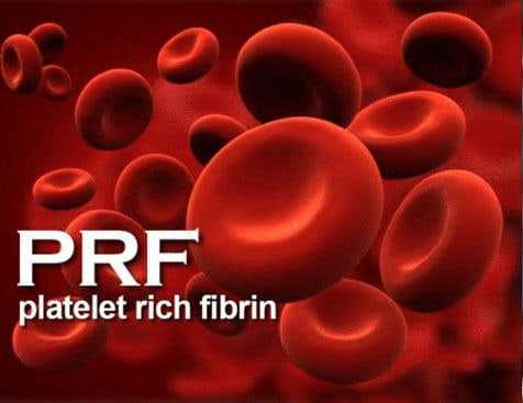 pdf 1 - Platelet Rich Fibrin Biomaterials