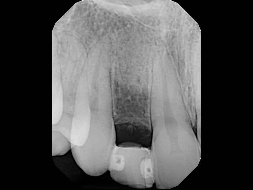 space between teeth 1 - Guided Dental Implant Surgery