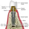 Implant Crown-Cement