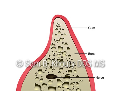 Jaw Augmentation 6 - Dental Implant Basics