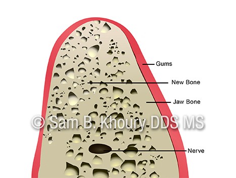 Jaw Augmentation 7 - Dental Implant Basics