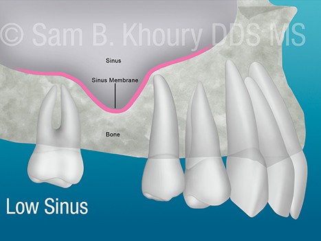 Low Sinus - Socket Preservation