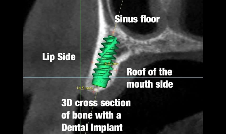 image five measured - Dental CT Scan "CBCT"