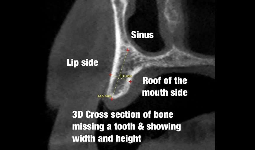 image six placement - Dental CT Scan "CBCT"
