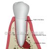 Tooth with Infection 1