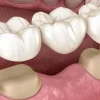 dental-bridge-model-2