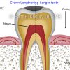 2 crown lengthening longer tooth