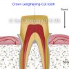 3 crown lengthening Cut tooth