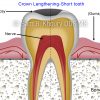 1 crown lengthening cavity before 1 crown lengthening cavity before