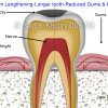 2 crown lengthening longer tooth 2 crown lengthening longer tooth