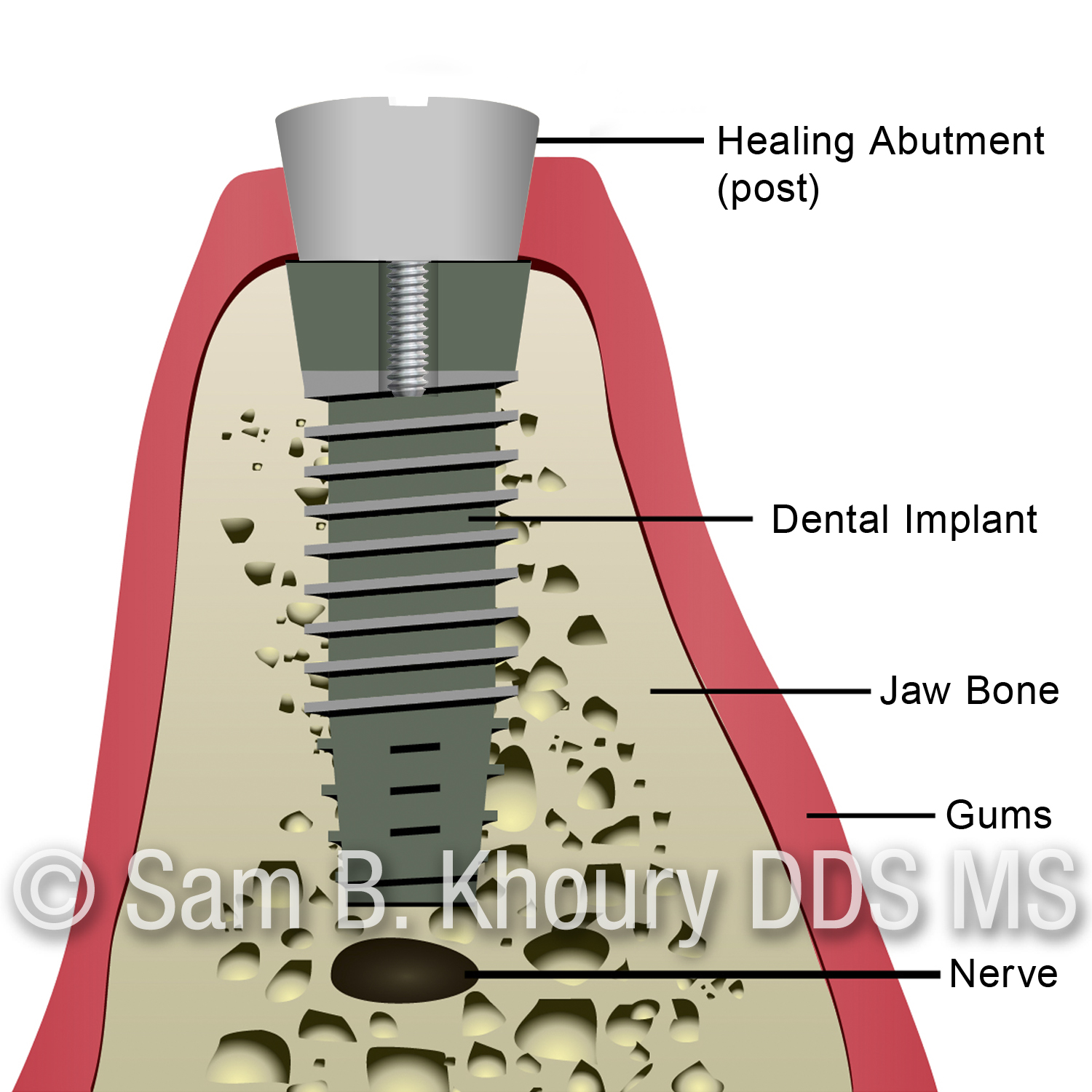 3 Implant uncovery