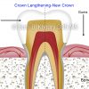 4 Crown Lengthening-New Crown 4 Crown Lengthening-New Crown